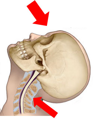 非骨傷性頚髄損傷 – よしむら脳神経・脊椎外科クリニック